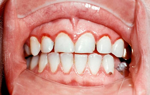 मसूड़े की सूजन के लक्षण क्या हैं
