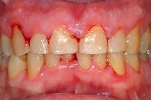 मसूड़े की सूजन के रूप क्या हैं