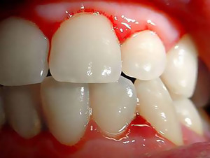 मसूड़े की सूजन के उपचार के पारंपरिक तरीके