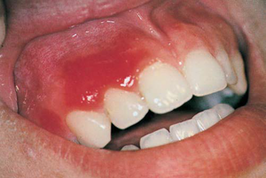 मसूड़े की सूजन का इलाज कैसे करें