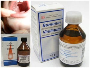 स्टामाटाइटिस के उपचार में विनीलिना का सकारात्मक प्रभाव