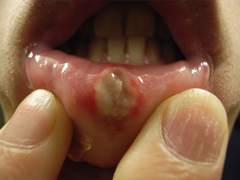 Stomatitis और इसके साथ लड़ो स्टामाटाइटिस का इलाज कैसे करें