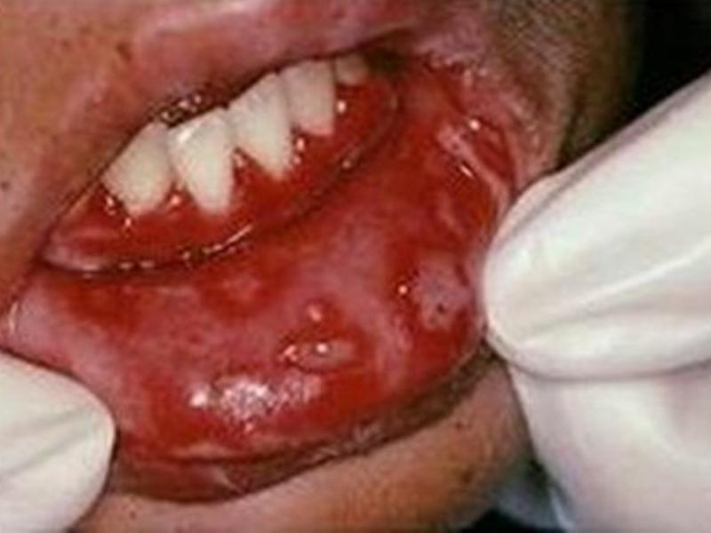 गंभीर स्टामाटाइटिस बच्चे के मुंह में छाले