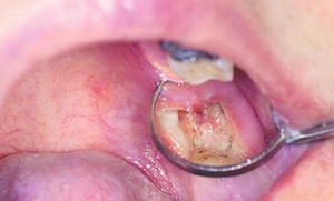 alveolitis दांत निकालने के बाद एल्वोलिटिस