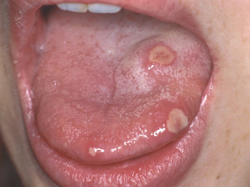 जीभ की नोक पर Stomatitis मौखिक गुहा में पेट की सूजन