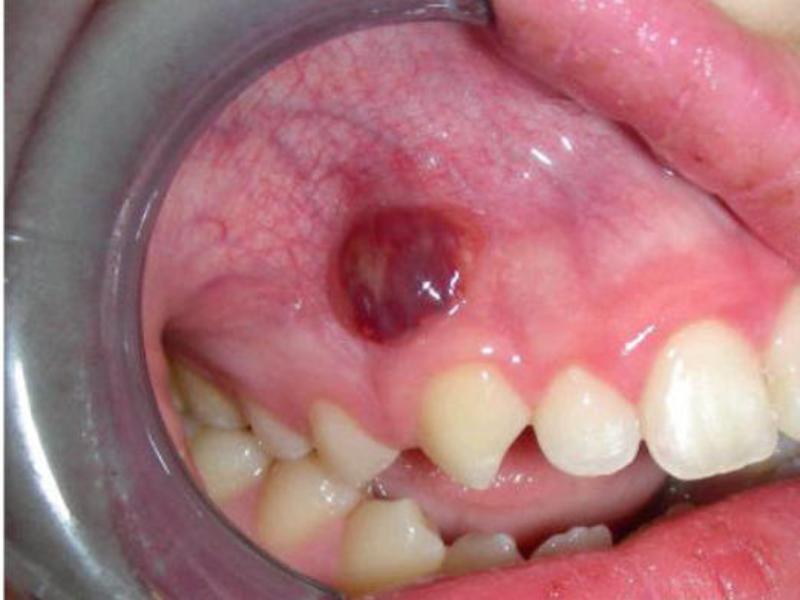मसूड़ों पर फ्लक्स फ्लक्स से लड़ने के तरीके