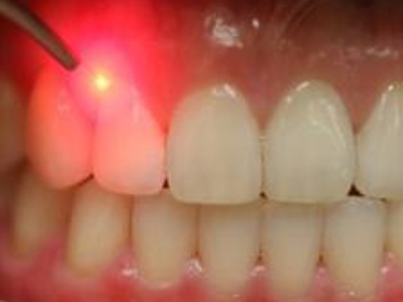 मसूड़ों की बीमारी मसूड़ों पर अल्सर