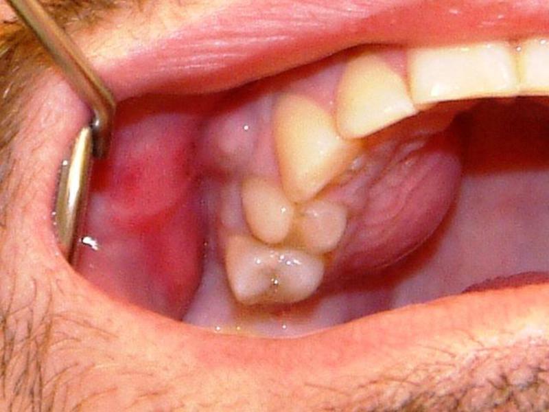 फ्लक्स का इलाज कैसे करें फ्लक्स का इलाज कैसे करें